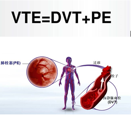 什么是VTE