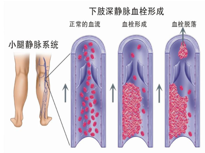 警惕！这个全球“第三大心血管杀手”，我们该如何应对？