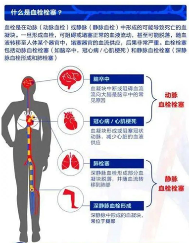 2022世界血栓日：就医有新路，血栓找介入