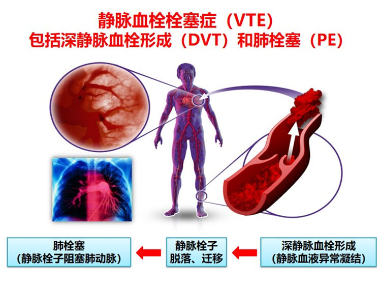 世界血栓日 | 拴不住，动起来