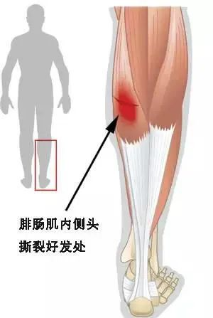 深静脉血栓类似病症的认识与区分