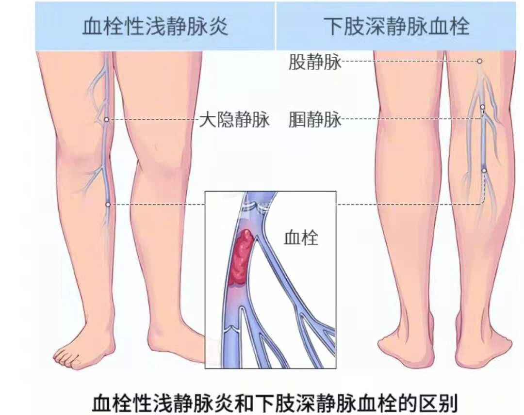 深静脉血栓类似病症的认识与区分