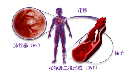 骨科术后重点关注的问题—VTE，该如何防治？