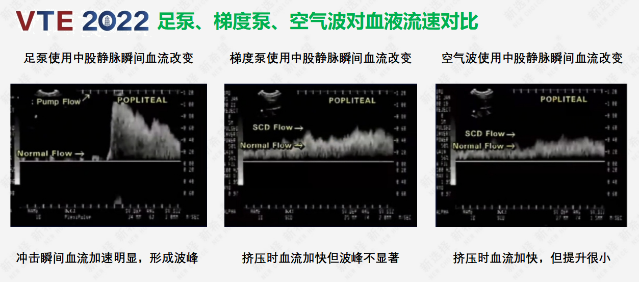 围术期患者VTE的预防，只知道抗凝可不行