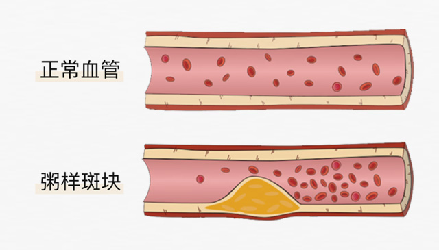 血栓是心梗、脑梗的元凶，很容易找上这些人