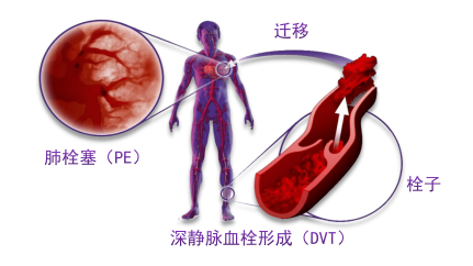 骨科术后重点关注的问题—VTE，该如何防治？